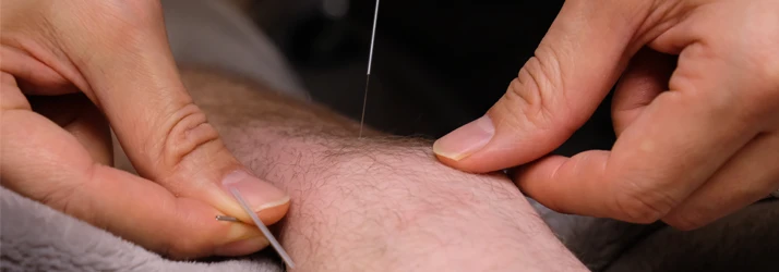 Acupuncture Treatment Being Done on a Patient